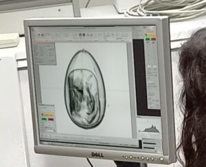 Oeuf en kinder au tomographe